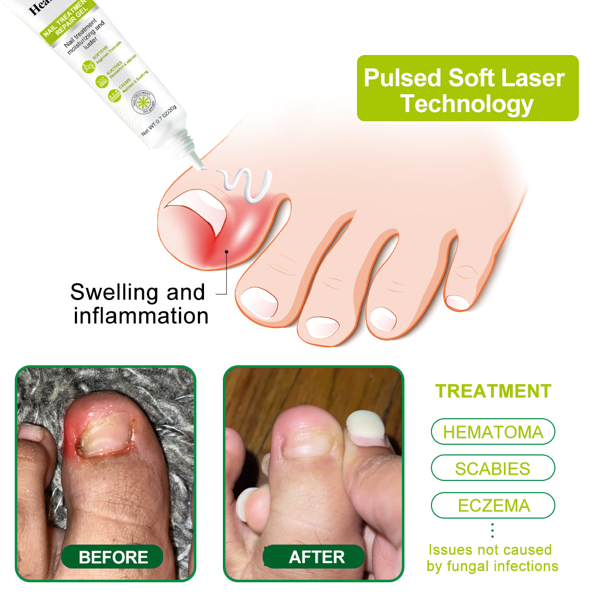 Healrize® NAIL TREATMENT REPAIR GEL(Removal Paronychia,Fungal infections, ingrown nail, discolored or damaged nails)💅