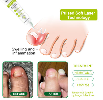 Healrize® NAIL TREATMENT REPAIR GEL(Removal Paronychia,Fungal infections, ingrown nail, discolored or damaged nails)💅