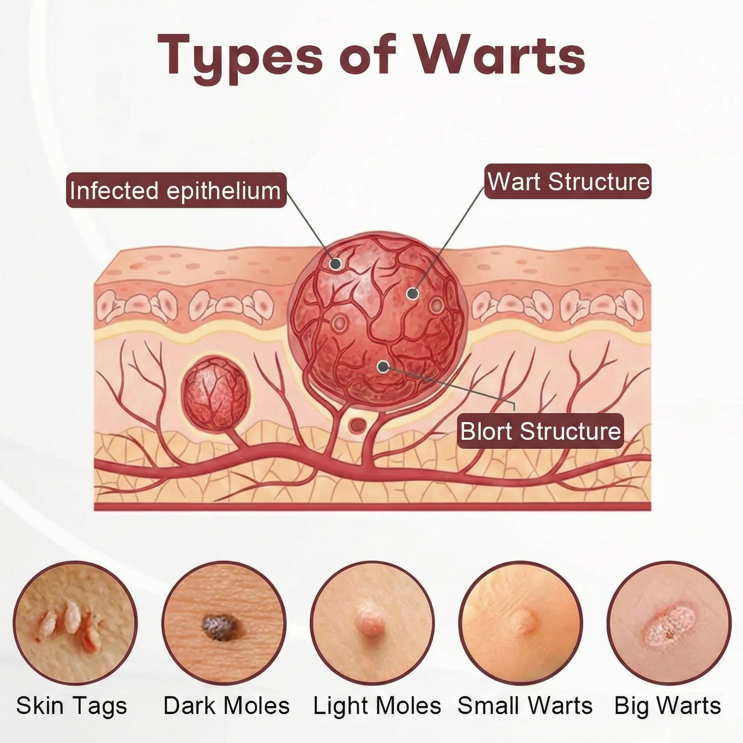 👩‍⚕️Made and Shipped from USA ✅Awzlove® Wart &Mole Removal All-in-One Cream🏆