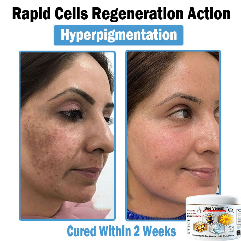 TODAHOF™ Bee Venom Multi-Symptom Skin Treatment Cream (NPF RECOMMENDS)💎
