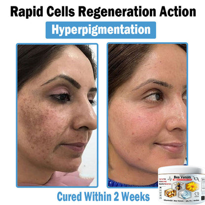 TODAHOF™ Bee Venom Multi-Symptom Skin Treatment Cream (NPF RECOMMENDS)💎