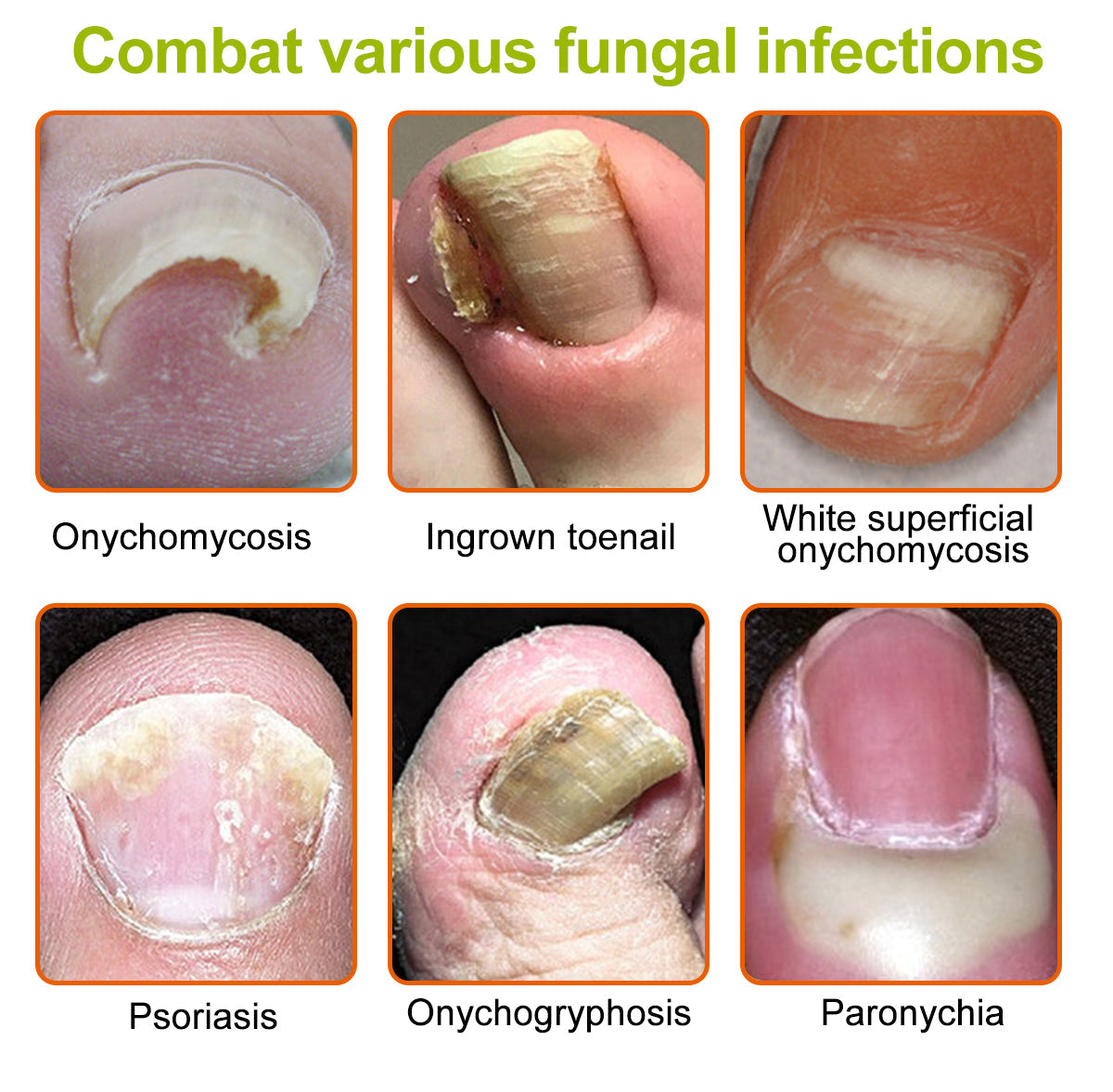 Healrize® NAIL TREATMENT REPAIR GEL(Removal Paronychia,Fungal infections, ingrown nail, discolored or damaged nails)💅