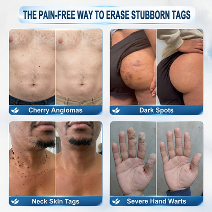 Healrize® 7-Day Tag & Spot Eraser 🪙(Painless Precision Rollerball for Skin Tags, Warts, Dark Spots & Raised Bumps) 🪙