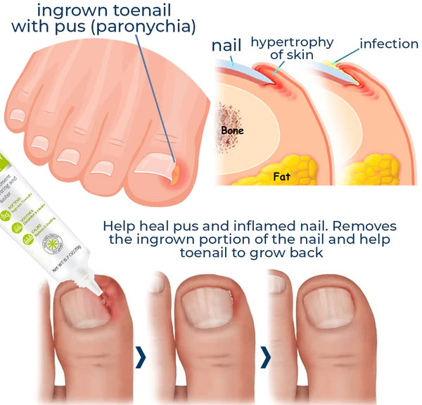 Healrize® NAIL TREATMENT REPAIR GEL(Removal Paronychia,Fungal infections, ingrown nail, discolored or damaged nails)💅