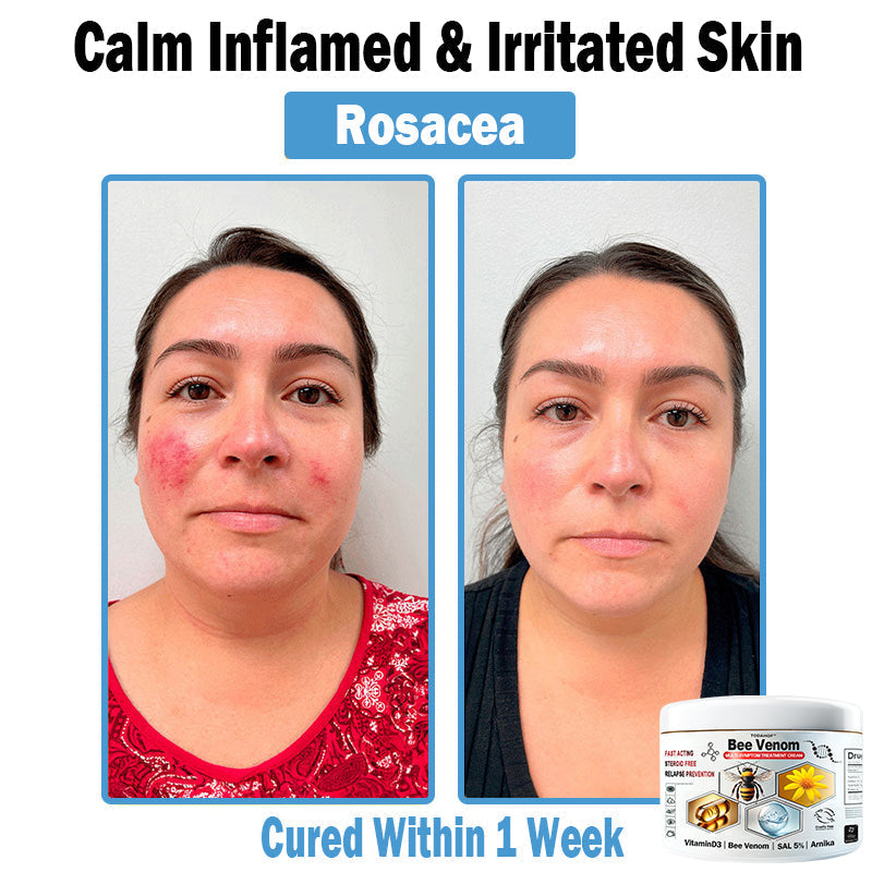 TODAHOF™ Bee Venom Multi-Symptom Skin Treatment Cream (NPF RECOMMENDS)💎