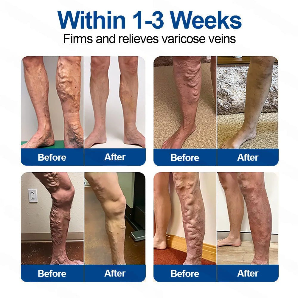 🇺🇸👨‍⚕️👍✅Healrize® VeinTarget Microneedle Patch🚀Instant Relief, Long-Term Results 🚀