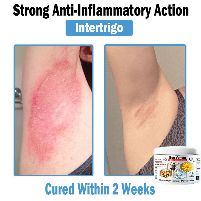 TODAHOF™ Bee Venom Multi-Symptom Skin Treatment Cream (NPF RECOMMENDS)💎
