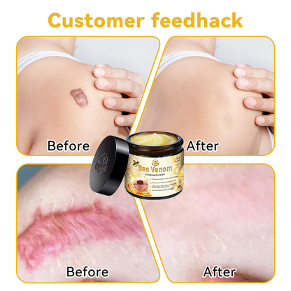 𝑇𝑢𝑟𝑜𝑛𝑢™ Bee Venom Skin Treatment Cream（𝐴𝐴𝐷 𝑅𝑒𝑐𝑜𝑚𝑚𝑒𝑛𝑑𝑒𝑑）🏵️