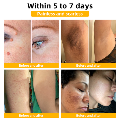 𝑇𝑢𝑟𝑜𝑛𝑢™ Bee Venom Skin Treatment Cream（𝐴𝐴𝐷 𝑅𝑒𝑐𝑜𝑚𝑚𝑒𝑛𝑑𝑒𝑑）🏵️