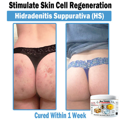 TODAHOF™ Bee Venom Multi-Symptom Skin Treatment Cream (NPF RECOMMENDS)💎