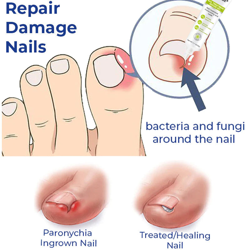 Healrize® NAIL TREATMENT REPAIR GEL(Removal Paronychia,Fungal infections, ingrown nail, discolored or damaged nails)💅