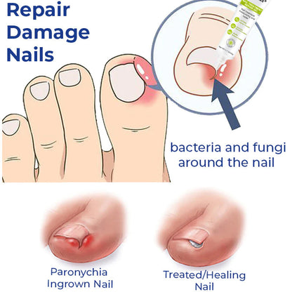 Healrize® NAIL TREATMENT REPAIR GEL(Removal Paronychia,Fungal infections, ingrown nail, discolored or damaged nails)💅