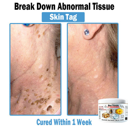 TODAHOF™ Bee Venom Multi-Symptom Skin Treatment Cream (NPF RECOMMENDS)💎