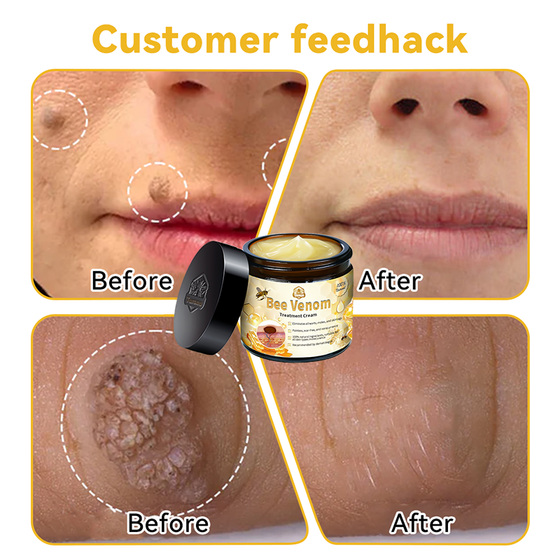 𝑇𝑢𝑟𝑜𝑛𝑢™ Bee Venom Skin Treatment Cream（𝐴𝐴𝐷 𝑅𝑒𝑐𝑜𝑚𝑚𝑒𝑛𝑑𝑒𝑑）🏵️