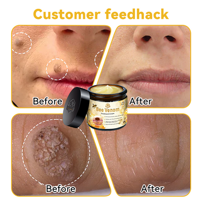 𝑇𝑢𝑟𝑜𝑛𝑢™ Bee Venom Skin Treatment Cream（𝐴𝐴𝐷 𝑅𝑒𝑐𝑜𝑚𝑚𝑒𝑛𝑑𝑒𝑑）🏵️