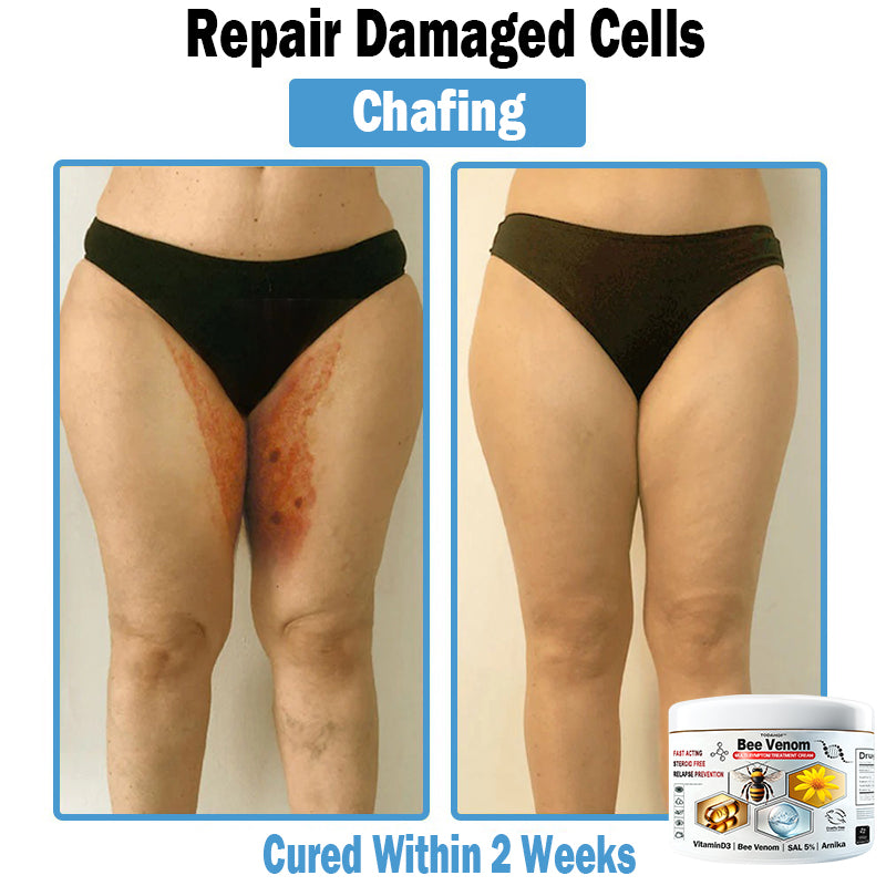TODAHOF™ Bee Venom Multi-Symptom Skin Treatment Cream (NPF RECOMMENDS)💎