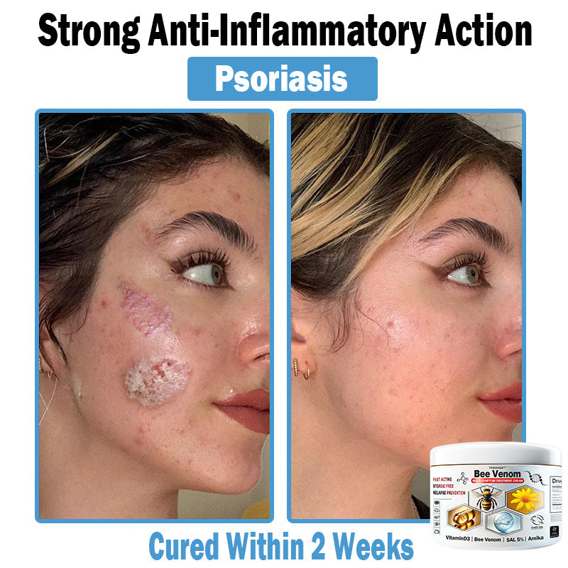 TODAHOF™ Bee Venom Multi-Symptom Skin Treatment Cream (NPF RECOMMENDS)💎