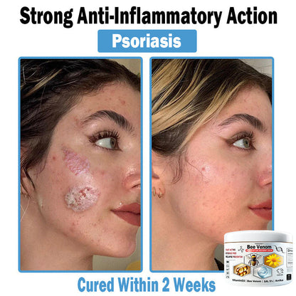 TODAHOF™ Bee Venom Multi-Symptom Skin Treatment Cream (NPF RECOMMENDS)💎